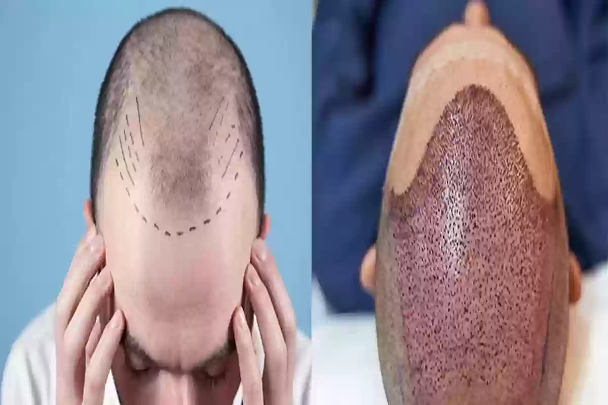 كم سنة تدوم زراعة الشعر وهل يبقى الشعر المزروع مدى الحياة؟!